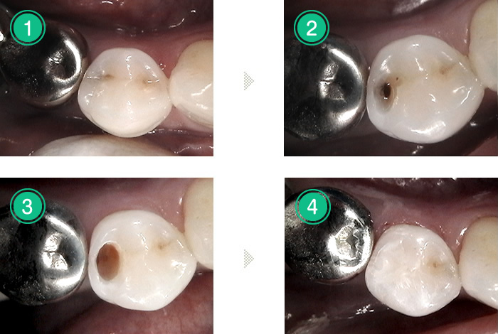 虫歯の治療例